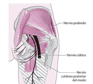 Ilustración anatómica de la compresión del nervio ciático en la pelvis durante el embarazo.