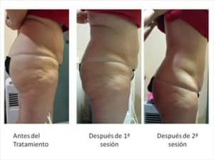 Comparativa técnica del tejido abdominal antes y después de un tratamiento de maderoterapia.